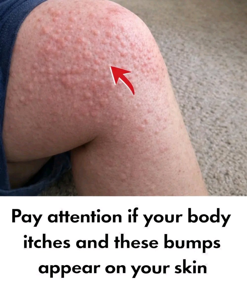 🤔 Why do hives appear on the skin?⚠️ Surprising triggers you may NOT know
