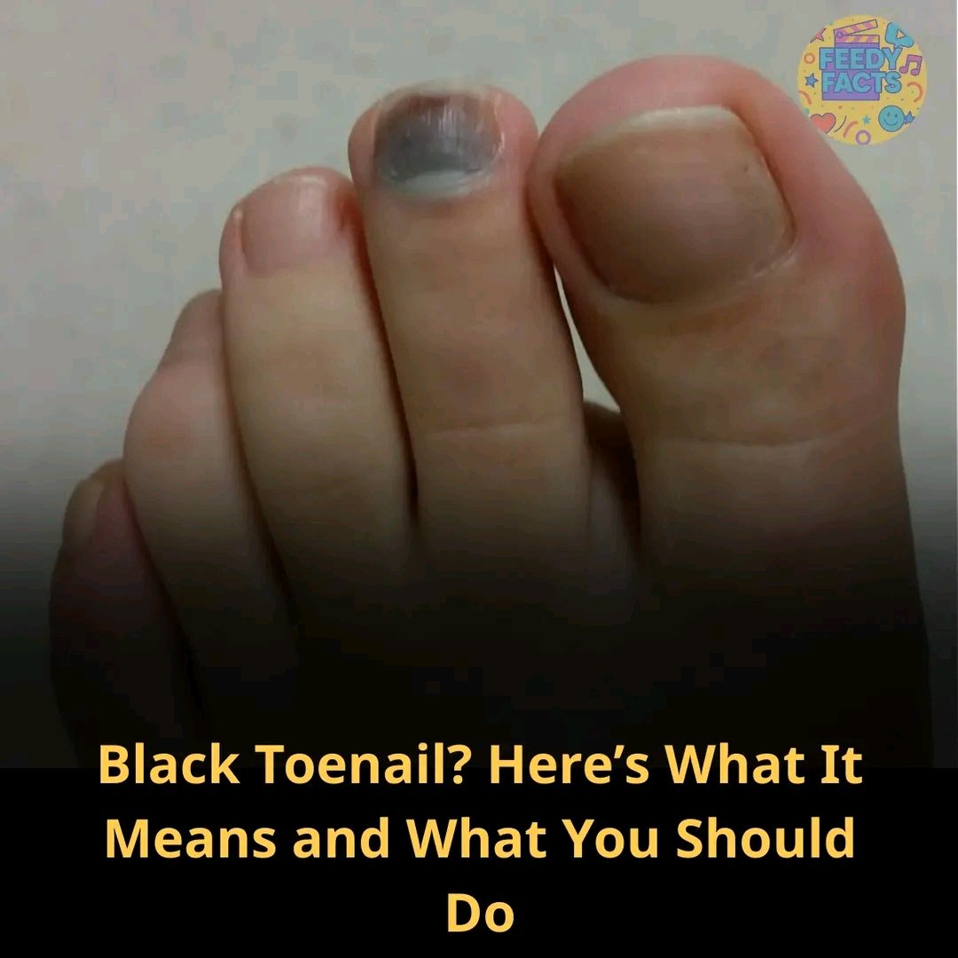 🖤 Black Toenail? Here’s What It Means — and How to Fix It