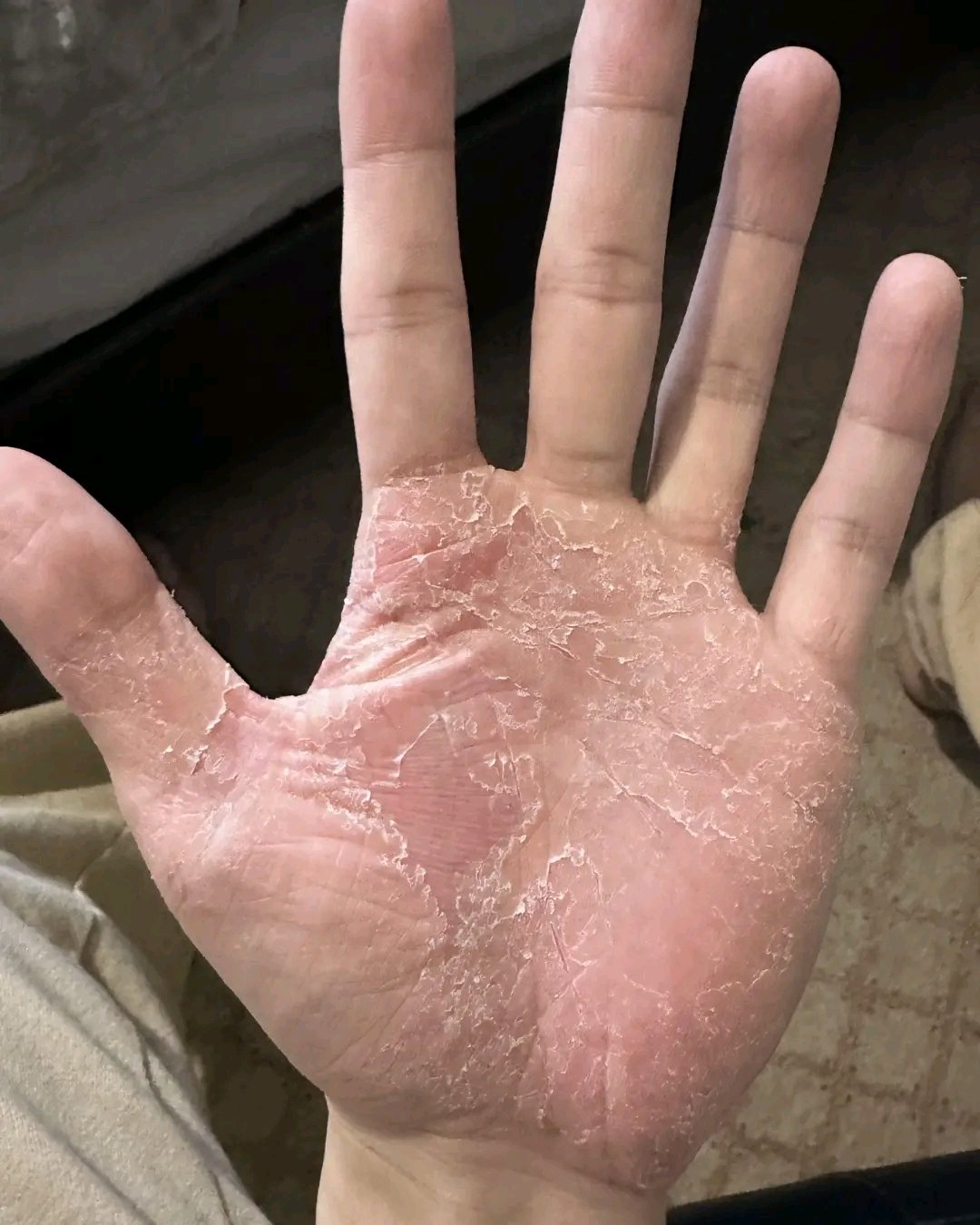 If This Appears on Your Hands, Be Careful: Why You Should Never Ignore These Warning Signs
