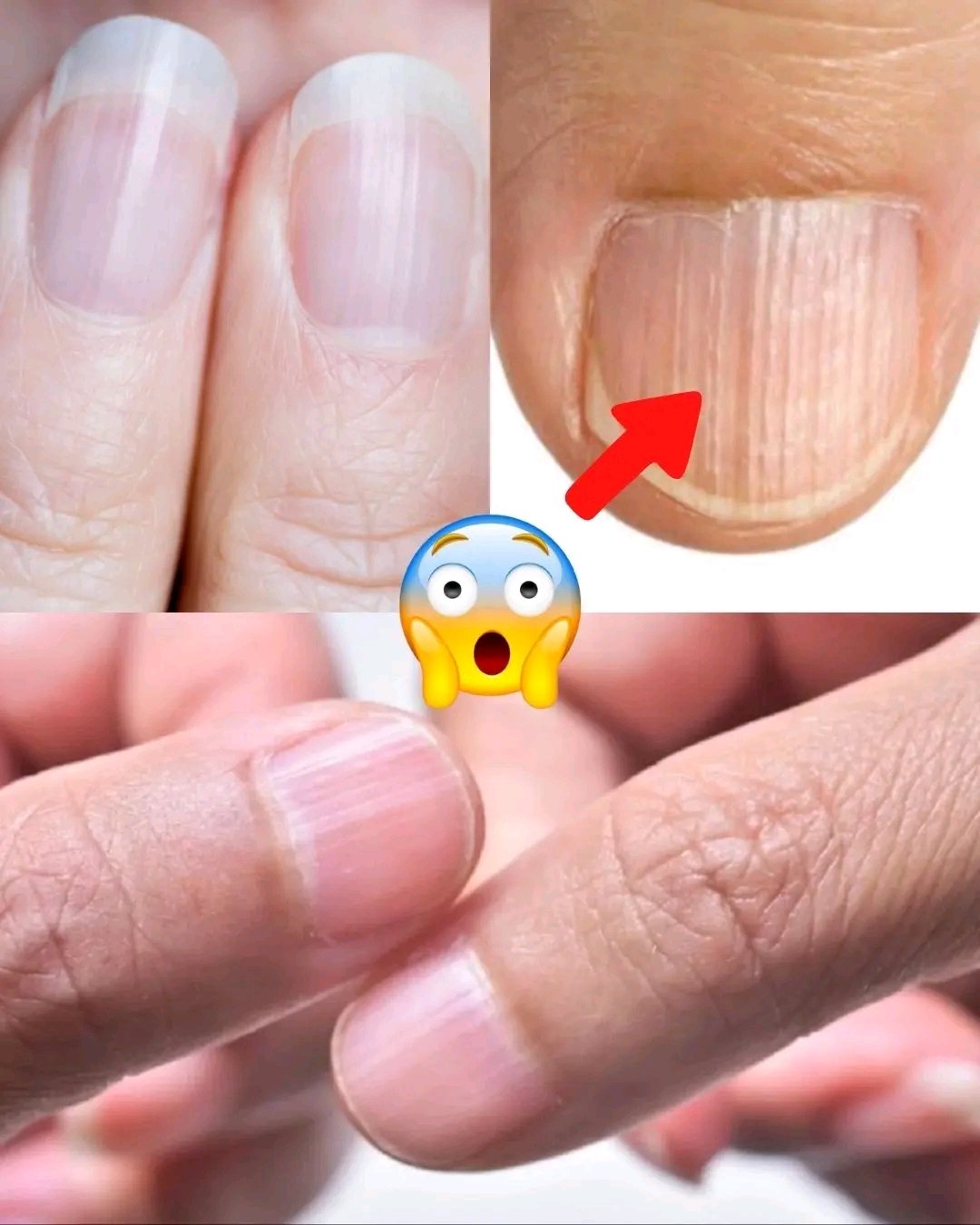 😳 Having Striped Nails Could Mean That Your Body Is… Trying to Tell You Something