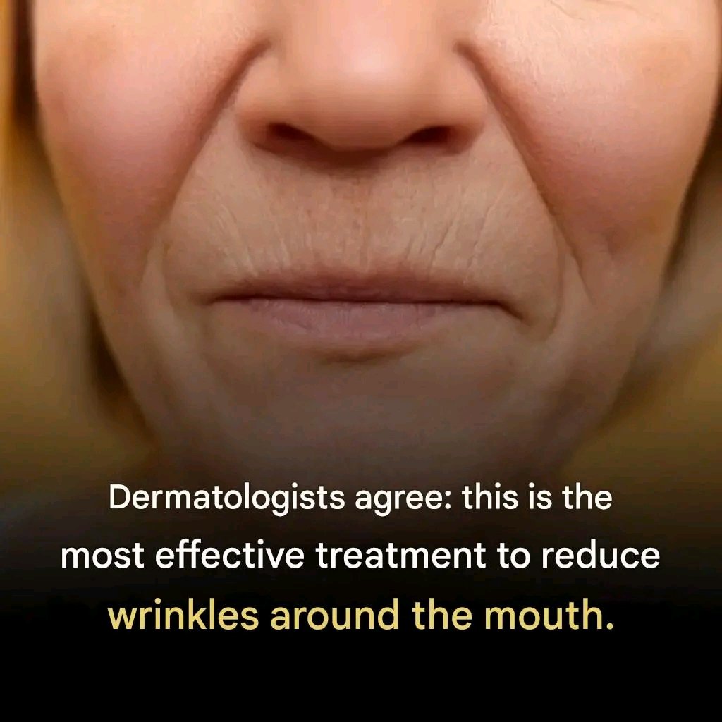💬 Dermatologists agree: this is the most effective treatment to reduce wrinkles around the mouth 👇