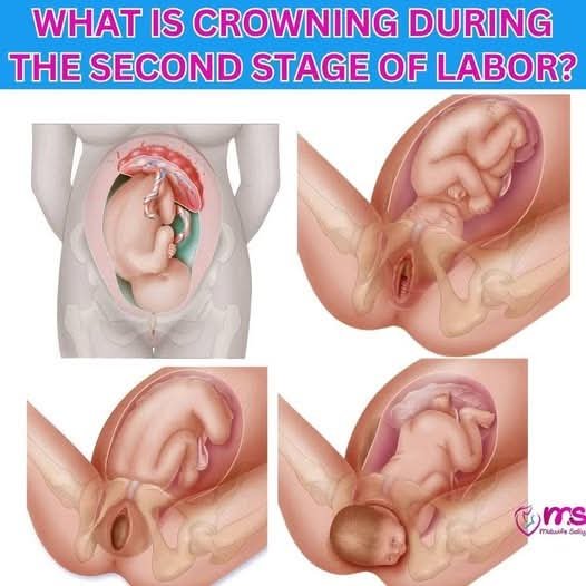 What Every Pregnant Woman Should Know About Crowning