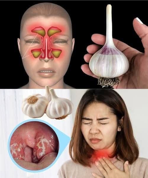 GARLIC and Urinary Tract Infection (UTI): What really helps – and what you should know before trying it