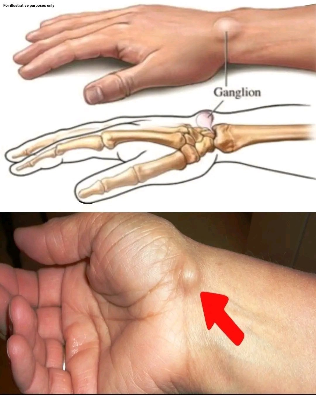 Noticing a Lump on Your Hand: What It Could Mean ✋⚠️