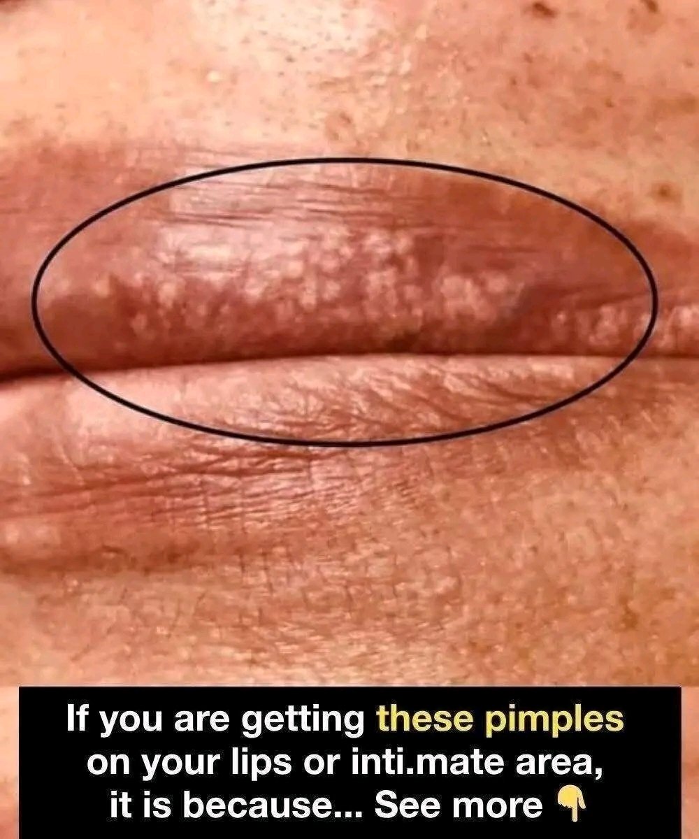 Pimples or bumps on the lips or intimate (genital) area can happen for several