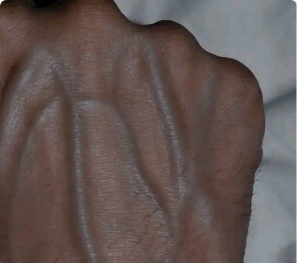 If Your Veins Are Visible in Your Hands, What Does It Mean?