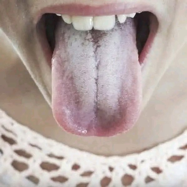 If your tongue is white, this is a clear sign that you may be suffering from…👇