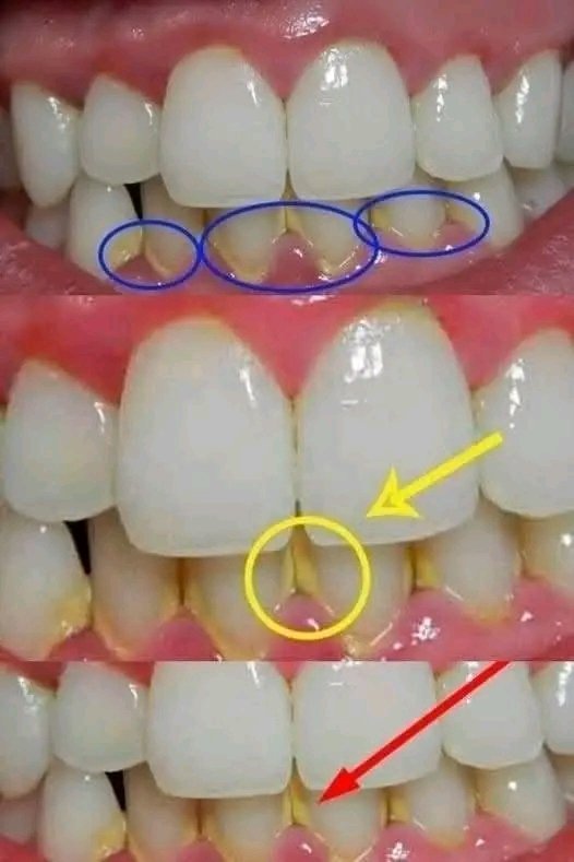 Remove Dental Plaque in 5 Minutes Naturally, Without Going to the Dentist 🦷