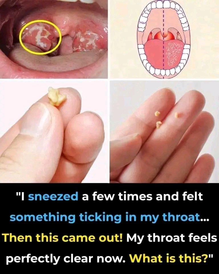 Here’s What You Need to Know About Tonsil Stones 👇🏼👇🏼👇🏼
