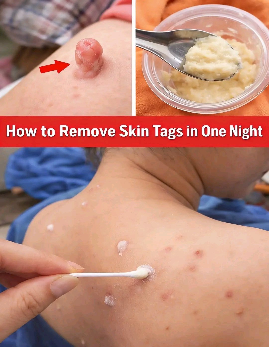 How to Remove Skin Tags Naturally at Home Using Vaseline