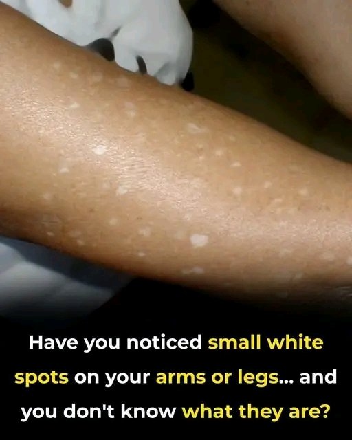 Small White Spots on Arms and Legs You Need To Know