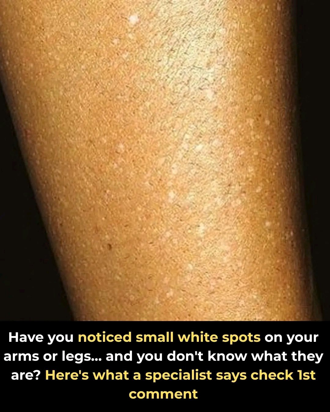 ⚪ Small White Spots on Arms or Legs: What Could They Be?