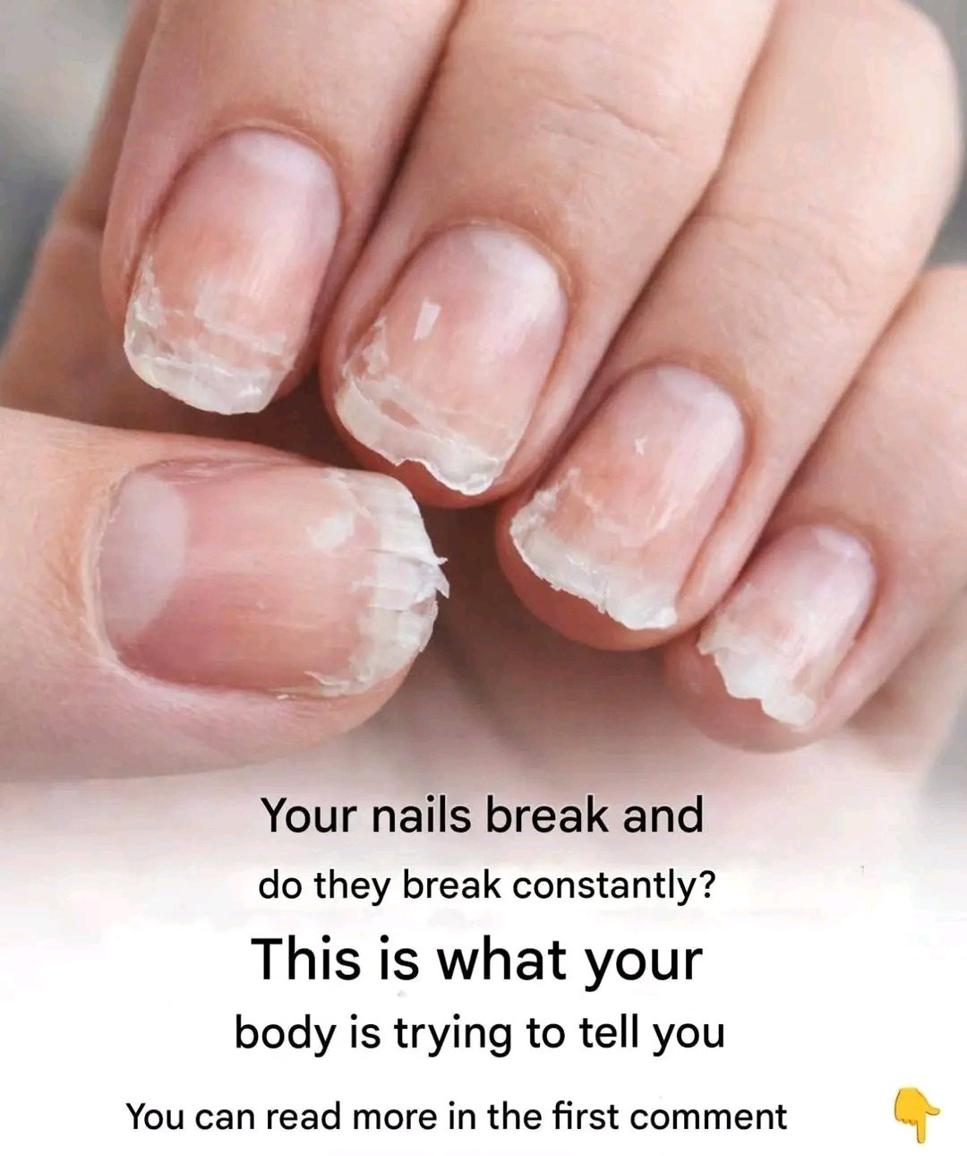 💅 Brittle or Fragile Nails: What Your Body Might Be Telling You