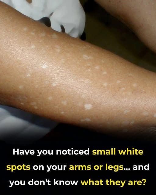 Small White Spots on Arms and Legs: What You Need to Know