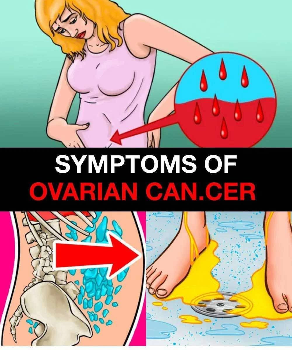 ⚠️ Symptoms of Ovarian Cancer You Shouldn’t Ignore