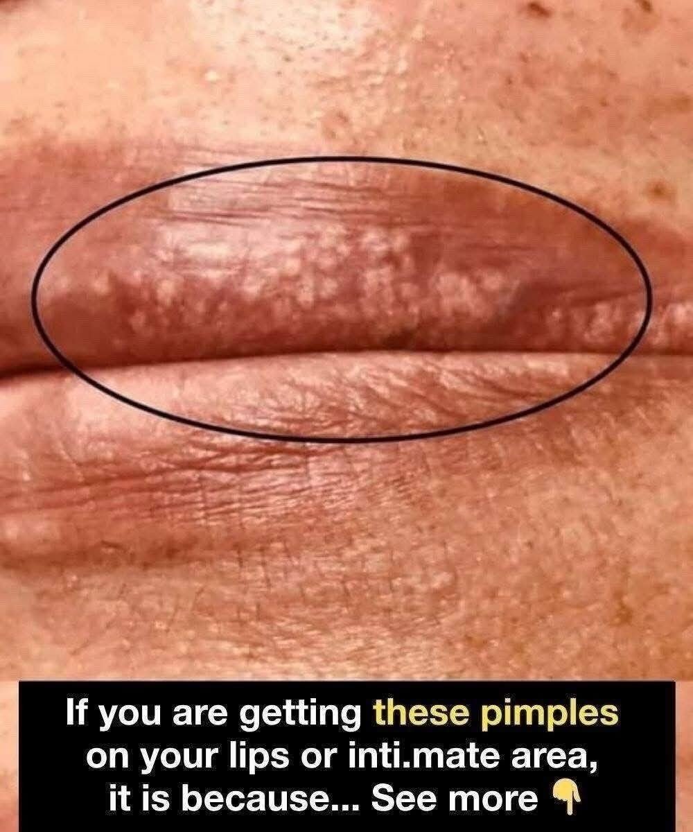 ⚠️ Pimples on Lips or Intimate Areas — What Could Be Causing Them?