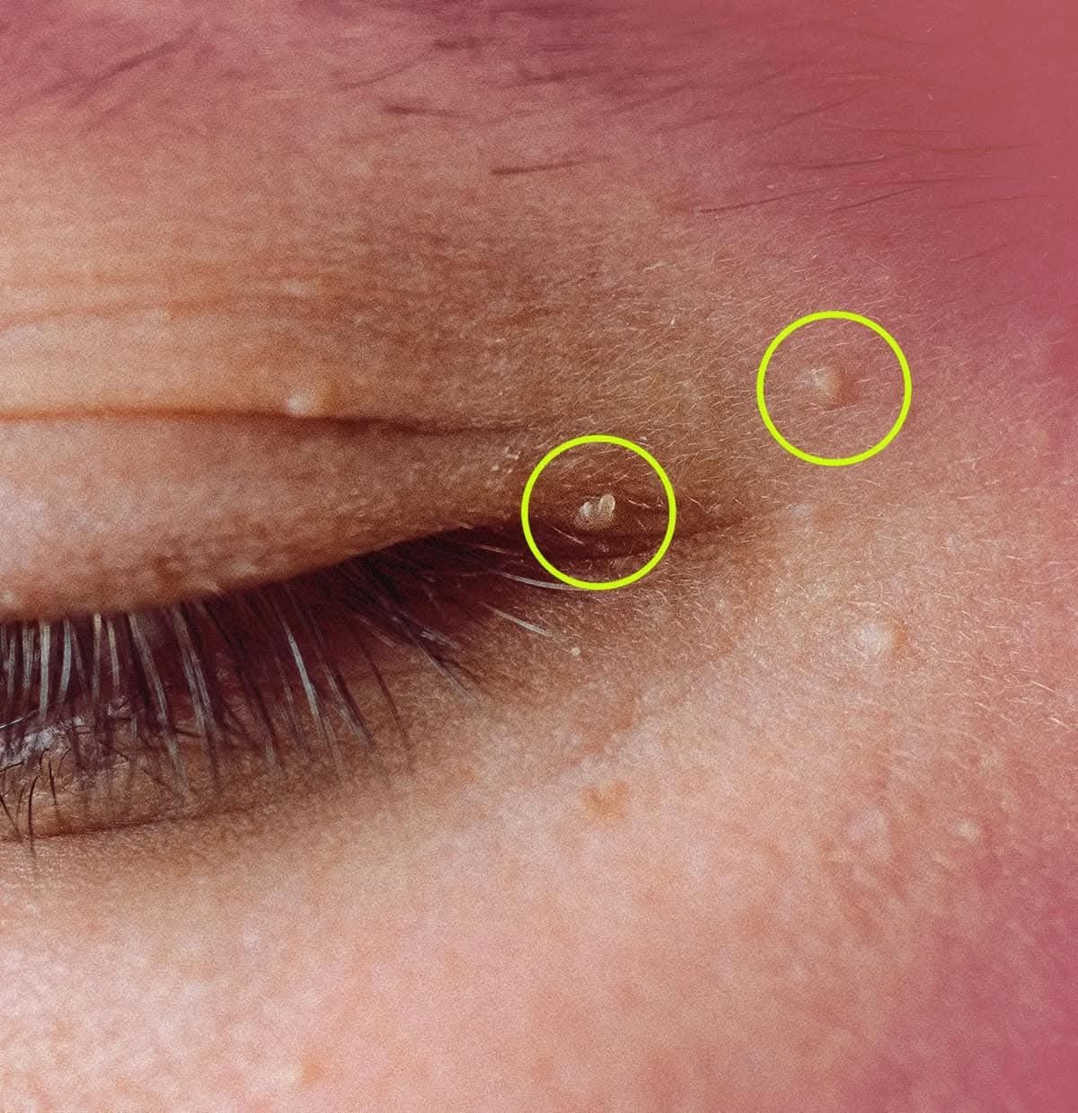 ✨ How to Get Rid of Milia (Those Annoying Tiny “Fat Cysts”)