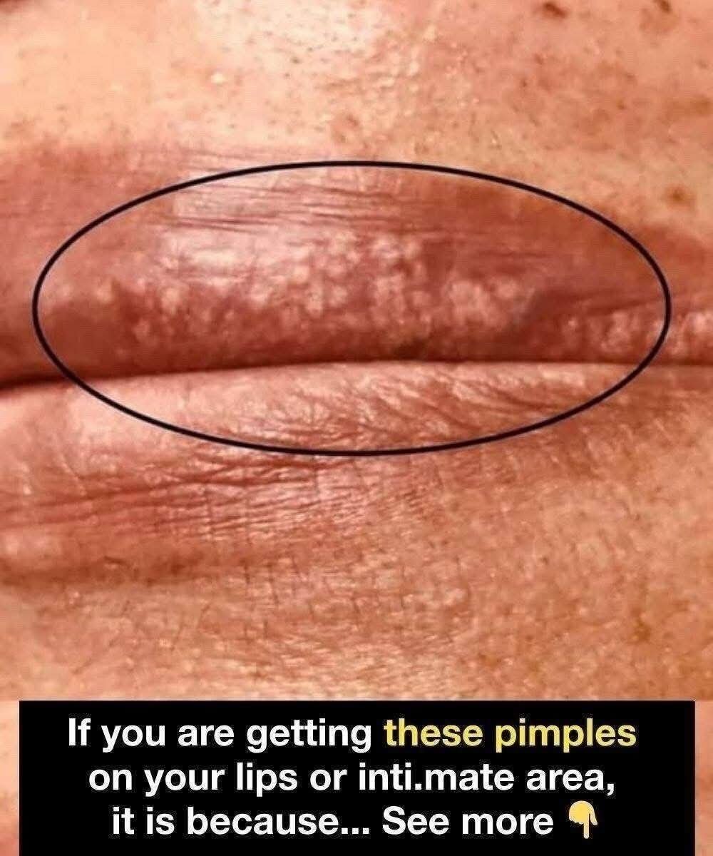 ⚠️ Pimples on Lips or Intimate Area — What They Could Mean