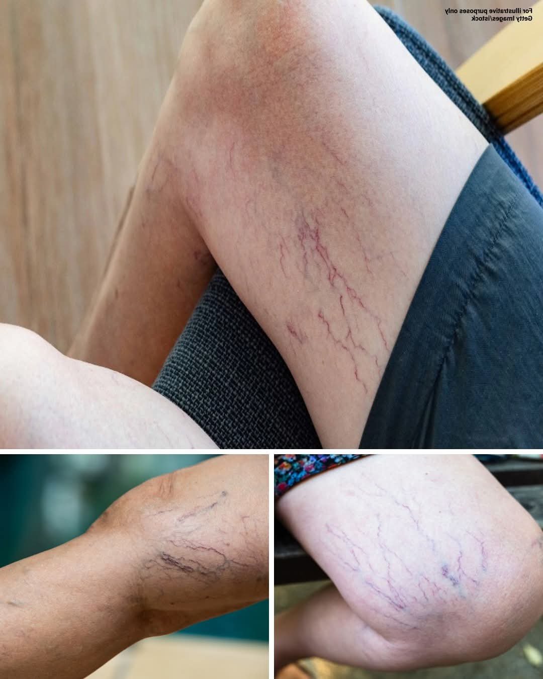 🦵 If You Have Purple Veins on Your Legs, It Could Mean…