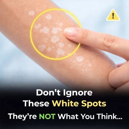 Noticed Tiny White Spots on Your Arms or Legs? Here’s What They Could Mean 🤔