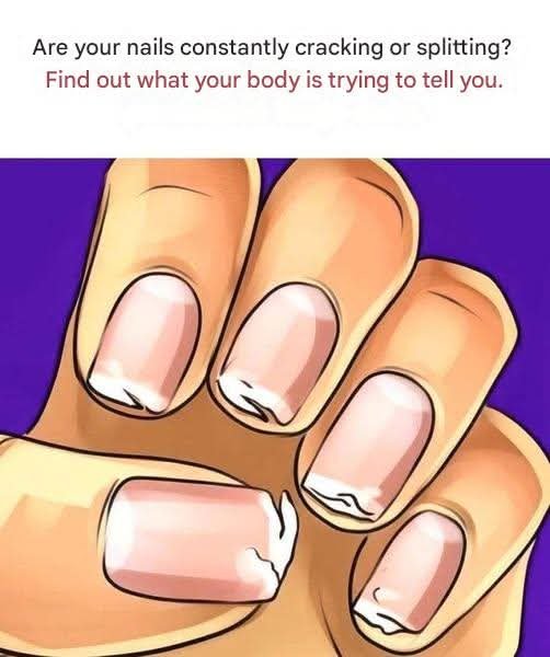 💅 Brittle, Cracking, or Splitting Nails? Your Body Might Be Sending a Signal