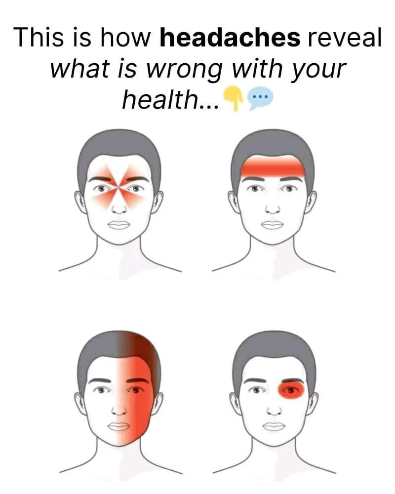 🧠 Major Types of Headaches & What Causes Them 👇💬