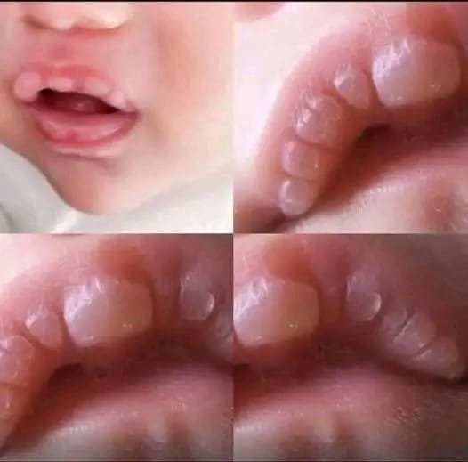 👶 Marks on a Baby’s Lips: What Could They Mean?