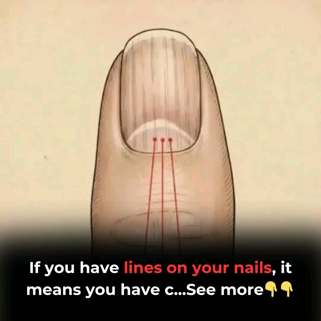 If You Have Lines on Your Nails, Here’s What Your Body Might Be Trying to Tell You 😮💅