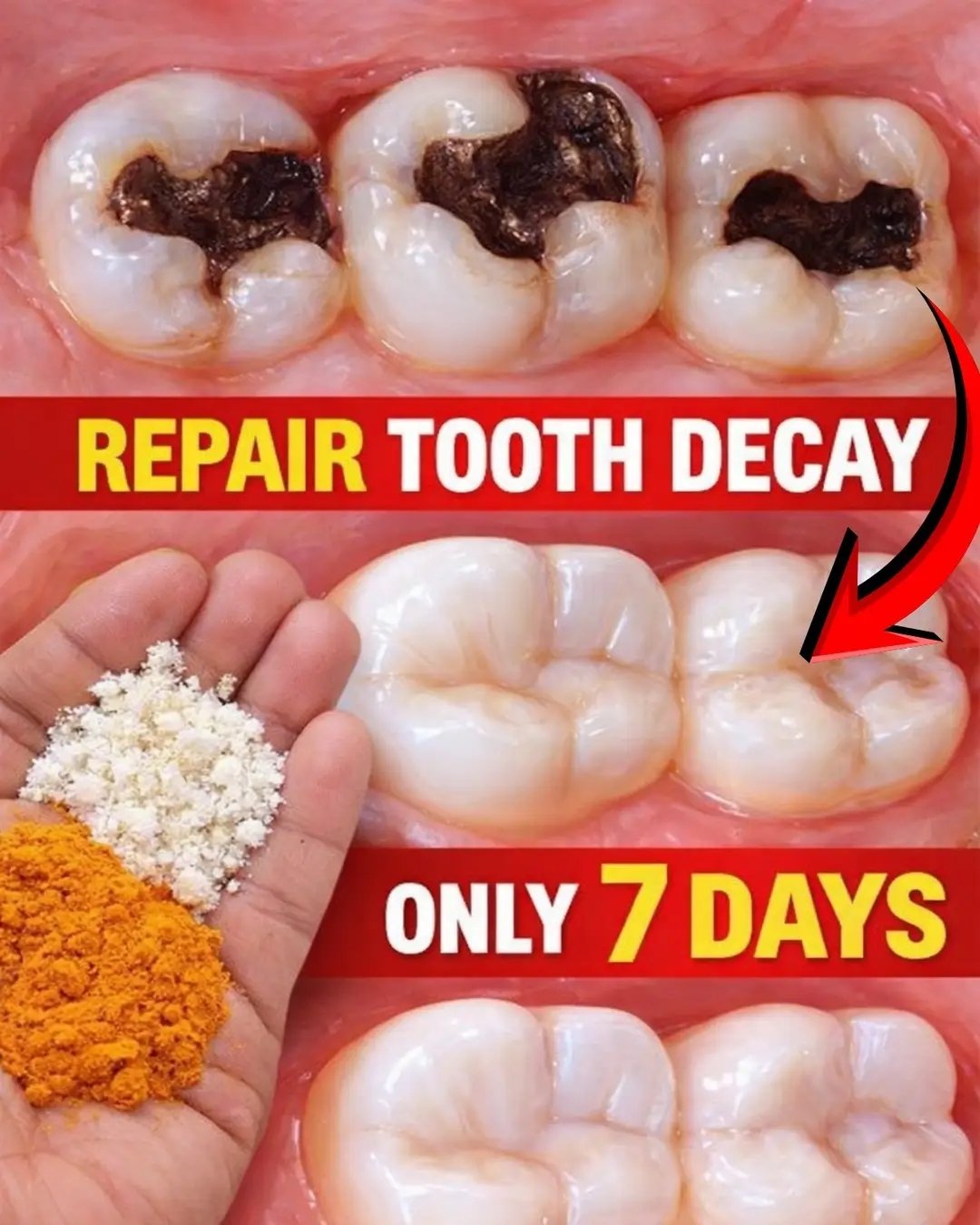 100% Natural Home Remedy for Tooth Decay, Yellow Teeth, and Tooth Pain 🦷✨